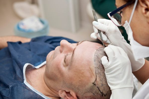 DHI Hair Transplant