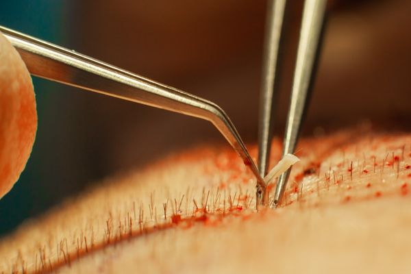 FUE Hair Transplant