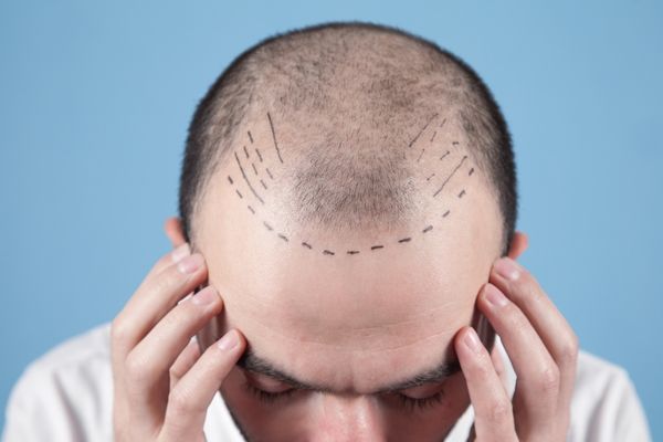 Hair Transplantation